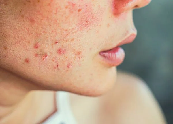Acné, rosácea y dermatitis
