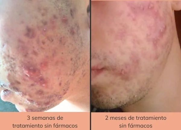 tratamiento natural para el acne a distancia