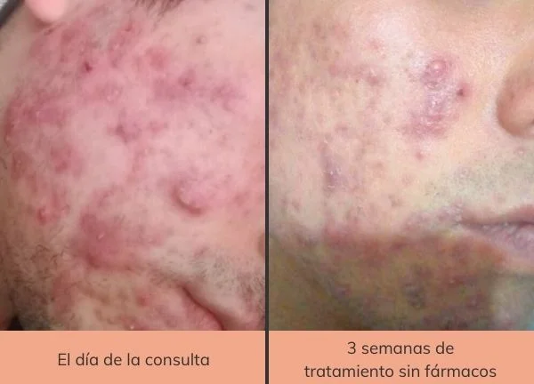 tratamiento natural para el acne