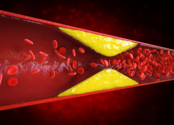 colesterol alto trigliceridos altos